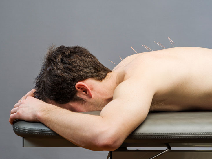 Acupuncture, natural treatments for erectile dysfunction